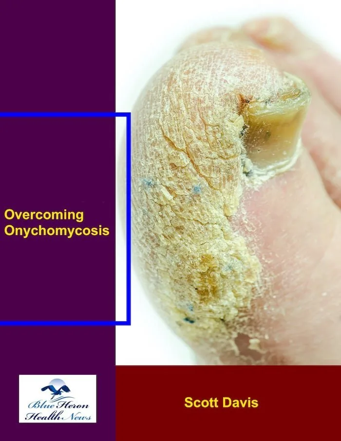 Overcoming Onychomycosis Reviews - Toenail Fungus Solutions Supplement Bottle